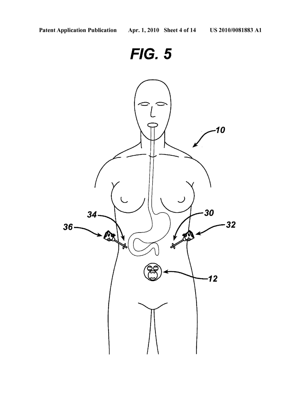 METHODS AND DEVICES FOR PERFORMING GASTROPLASTIES USING A MULTIPLE PORT ACCESS DEVICE - diagram, schematic, and image 05