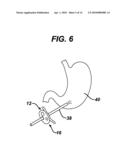 METHODS AND DEVICES FOR PERFORMING GASTROPLASTIES USING A MULTIPLE PORT ACCESS DEVICE diagram and image