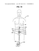 METHODS AND DEVICES FOR PERFORMING GASTROPLASTIES USING A MULTIPLE PORT ACCESS DEVICE diagram and image