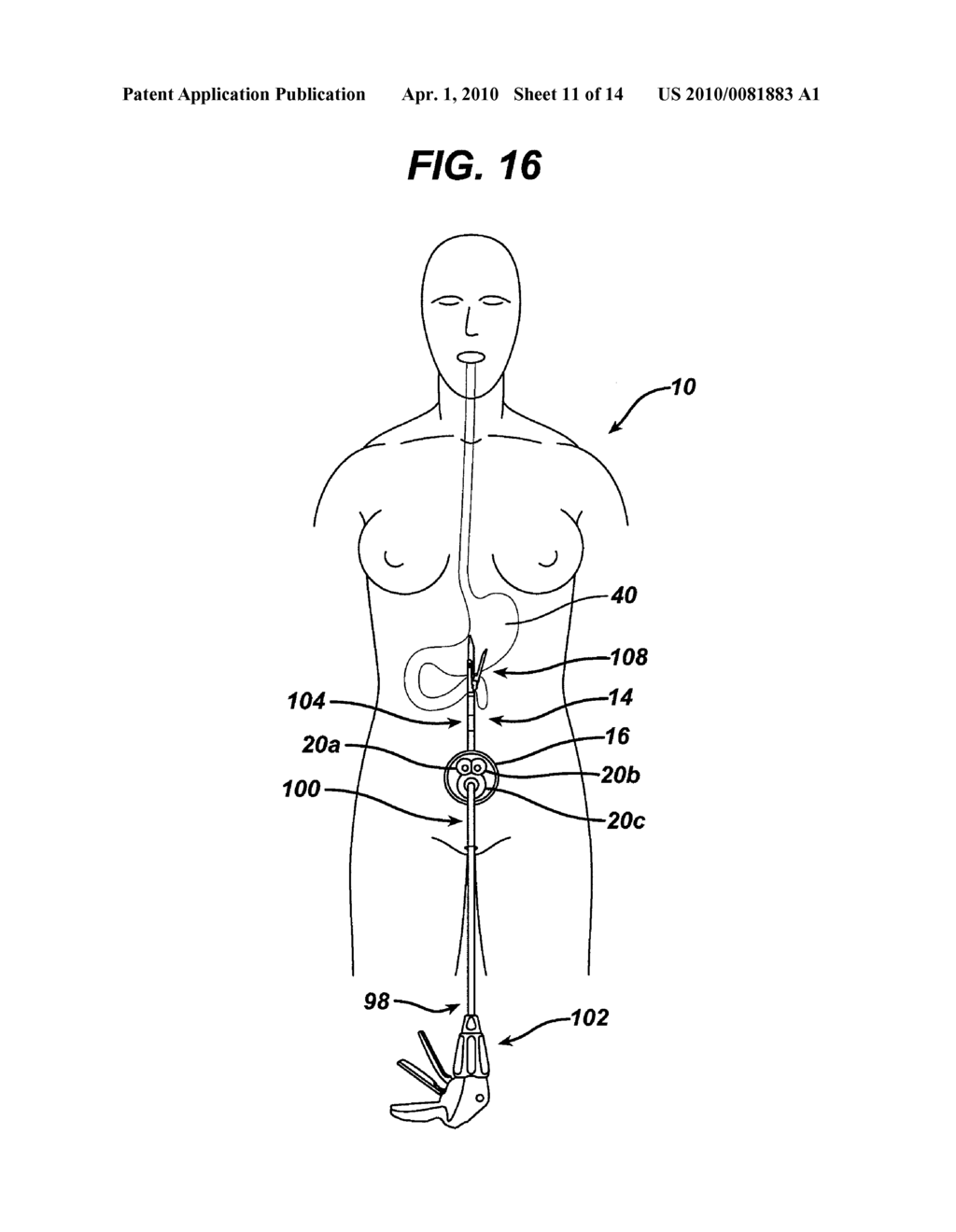 METHODS AND DEVICES FOR PERFORMING GASTROPLASTIES USING A MULTIPLE PORT ACCESS DEVICE - diagram, schematic, and image 12