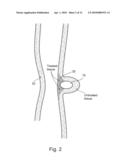 TREATING WEAKENED VESSEL WALL SUCH AS VULNERABLE PLAQUE OR ANEURYSMS diagram and image