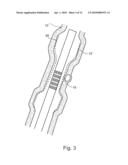 TREATING WEAKENED VESSEL WALL SUCH AS VULNERABLE PLAQUE OR ANEURYSMS diagram and image