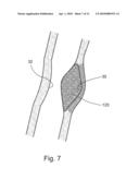 TREATING WEAKENED VESSEL WALL SUCH AS VULNERABLE PLAQUE OR ANEURYSMS diagram and image