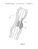 TREATING WEAKENED VESSEL WALL SUCH AS VULNERABLE PLAQUE OR ANEURYSMS diagram and image