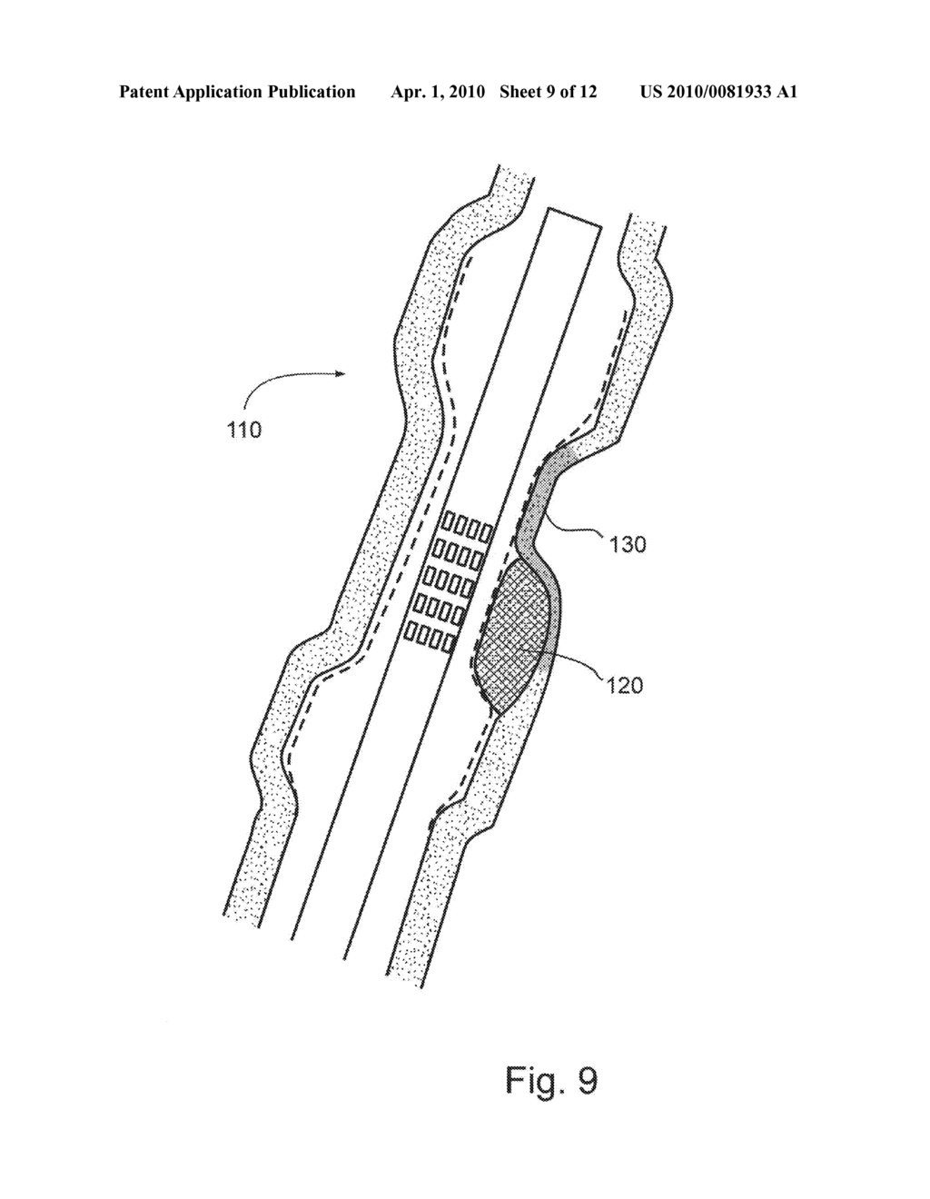 TREATING WEAKENED VESSEL WALL SUCH AS VULNERABLE PLAQUE OR ANEURYSMS - diagram, schematic, and image 10