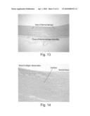 TREATING WEAKENED VESSEL WALL SUCH AS VULNERABLE PLAQUE OR ANEURYSMS diagram and image