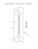 TREATMENT OF VASCULAR OCCLUSIONS USING ULTRASONIC ENERGY AND MICROBUBBLES diagram and image