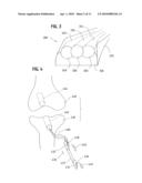 Materials and Methods for Improved Bone Tendon Bone Transplantation diagram and image