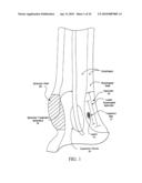 Sphincter treatment apparatus diagram and image