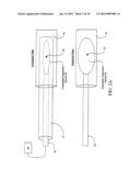 Sphincter treatment apparatus diagram and image