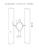 Sphincter treatment apparatus diagram and image