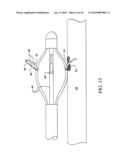 Sphincter treatment apparatus diagram and image