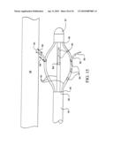 Sphincter treatment apparatus diagram and image