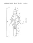 Sphincter treatment apparatus diagram and image