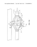 Sphincter treatment apparatus diagram and image