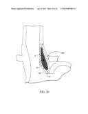 Sphincter treatment apparatus diagram and image