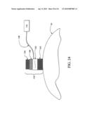 Sphincter treatment apparatus diagram and image