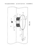 Sphincter treatment apparatus diagram and image