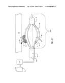 Sphincter treatment apparatus diagram and image