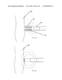 Electrosurgical Plenum diagram and image