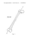 INTRAMEDULLARY OSTEOSYNTHESIS DEVICE diagram and image