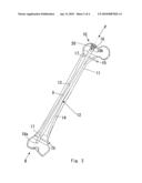 INTRAMEDULLARY OSTEOSYNTHESIS DEVICE diagram and image