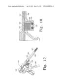 Tissue Distraction Device diagram and image