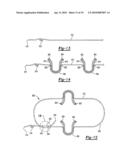 Soft Tissue Repair Device and Method diagram and image