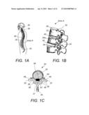 SPINOUS PROCESS FIXATION IMPLANT diagram and image