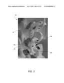 SPINOUS PROCESS FIXATION IMPLANT diagram and image