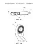 SPINOUS PROCESS FIXATION IMPLANT diagram and image