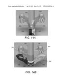 SPINOUS PROCESS FIXATION IMPLANT diagram and image