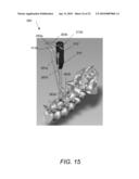 SPINOUS PROCESS FIXATION IMPLANT diagram and image