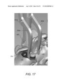 SPINOUS PROCESS FIXATION IMPLANT diagram and image