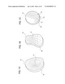 METHODS OF IMPLANTING GLENOID INLAY diagram and image