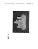 METHODS OF IMPLANTING GLENOID INLAY diagram and image