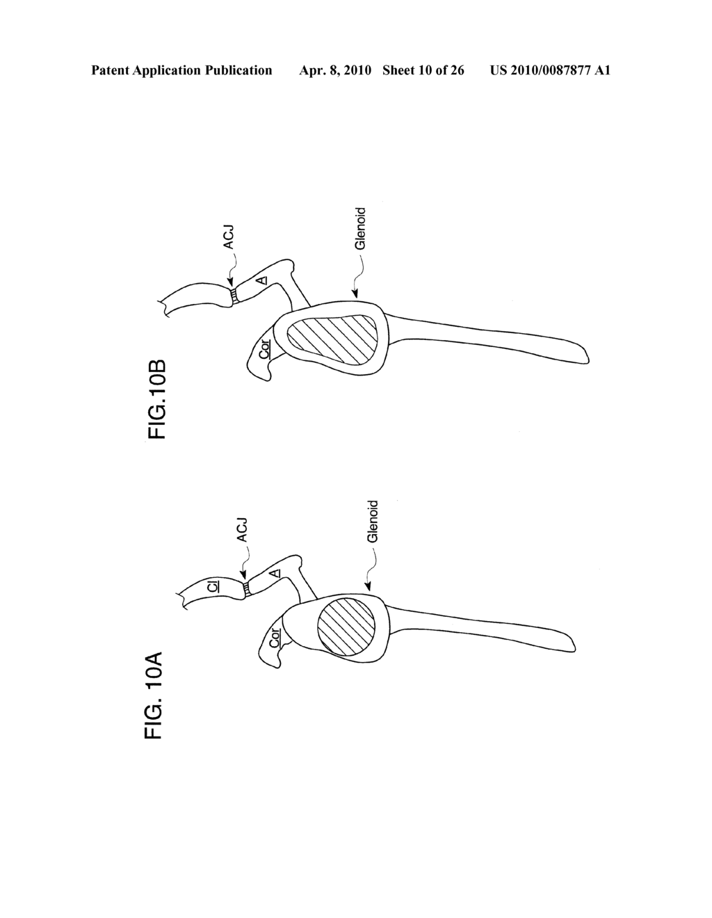METHODS OF IMPLANTING GLENOID INLAY - diagram, schematic, and image 11