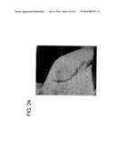 METHODS OF IMPLANTING GLENOID INLAY diagram and image