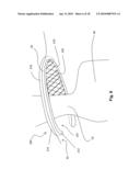 SYSTEMS AND METHODS FOR VALVE ANNULUS REMODELING diagram and image