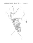 SYSTEMS AND METHODS FOR VALVE ANNULUS REMODELING diagram and image