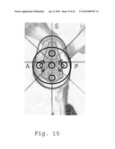 REVERSE SHOULDER PROSTHESIS diagram and image