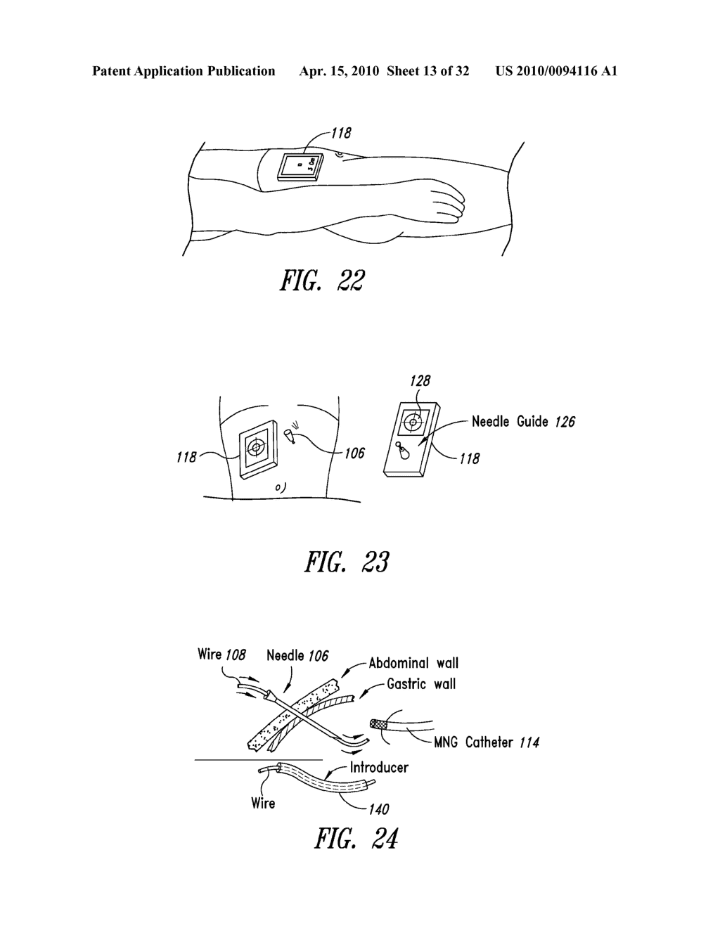 PERCUTANEOUS MAGNETIC GASTROSTOMY - diagram, schematic, and image 14