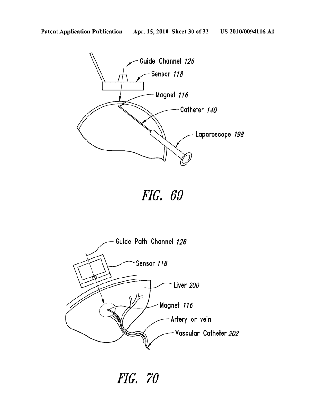 PERCUTANEOUS MAGNETIC GASTROSTOMY - diagram, schematic, and image 31