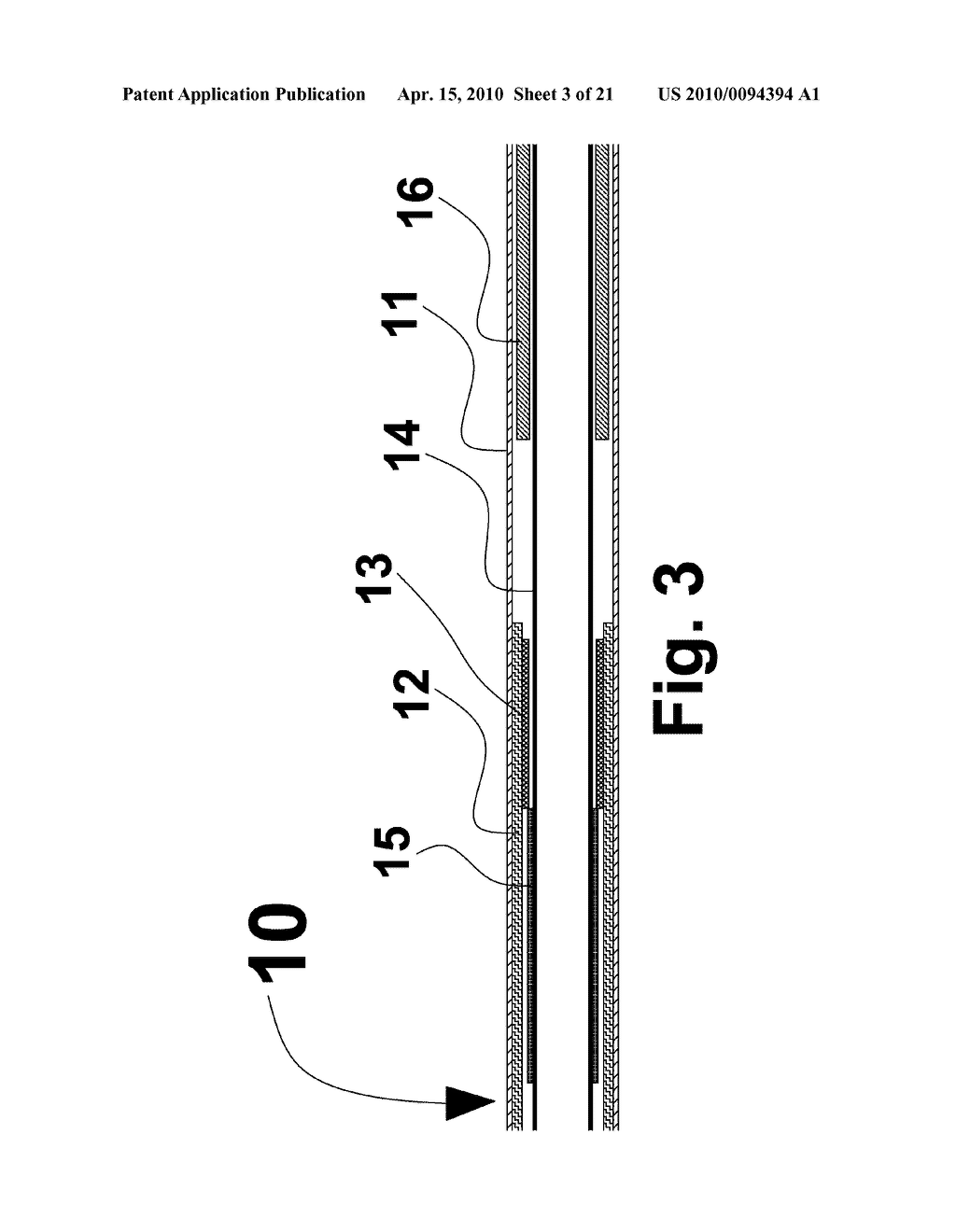 RECONSTRAINABLE STENT DELIVERY SYSTEM - diagram, schematic, and image 04