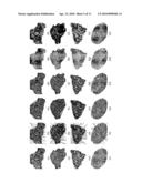 MALIGNANCY DIAGNOSIS USING CONTENT - BASED IMAGE RETREIVAL OF TISSUE HISTOPATHOLOGY diagram and image