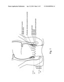 FECAL INCONTINENCE DEVICE, KIT AND METHOD diagram and image