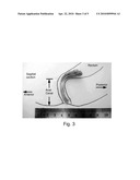 FECAL INCONTINENCE DEVICE, KIT AND METHOD diagram and image