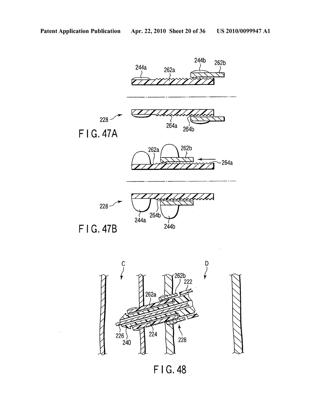 FISTULECTOMY METHOD OF FORMING A FISTULA BETWEEN A FIRST DUCT AND A SECOND DUCT - diagram, schematic, and image 21