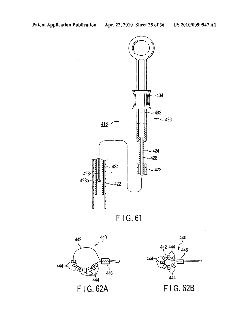 FISTULECTOMY METHOD OF FORMING A FISTULA BETWEEN A FIRST DUCT AND A SECOND DUCT - diagram, schematic, and image 26