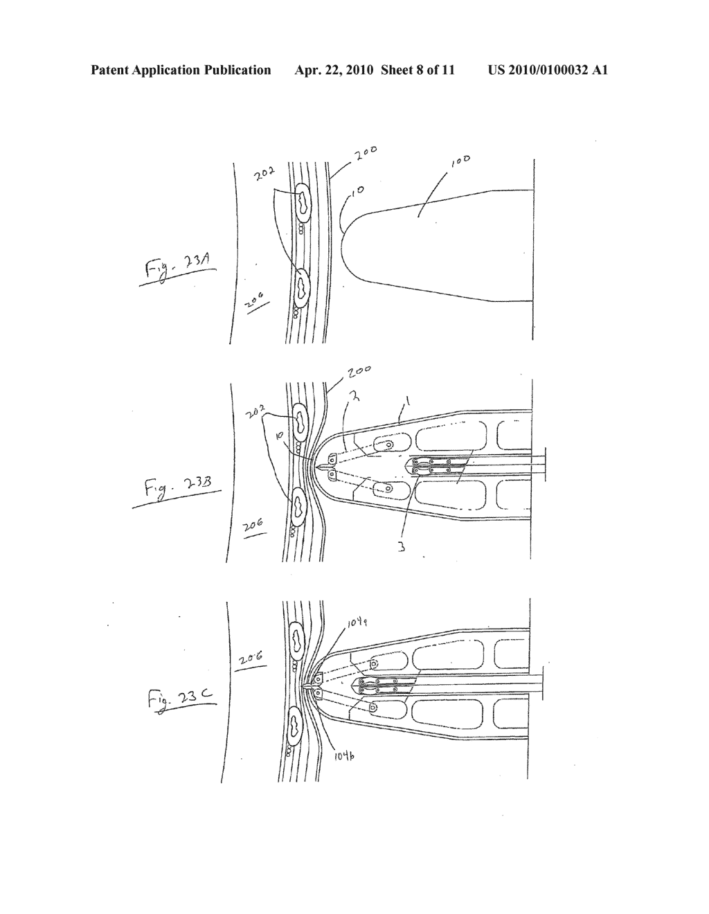 CHEST DRAINAGE AND APPARATUS FOR THE INSERTION THEREOF - diagram, schematic, and image 09